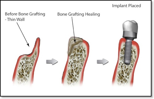 bone grafting for dental implant with thin wall